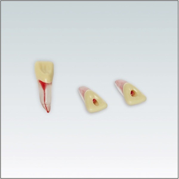 ANA4ZPUKN21 Diente endodoncia con raíz natural transparente (235623)