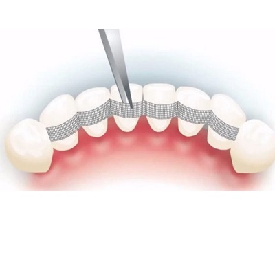 Fibras Ferulización