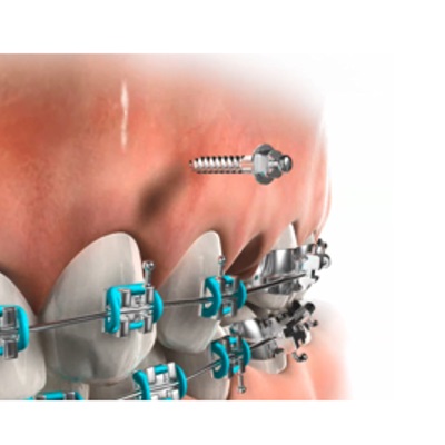 Mini implantes ortodónticos