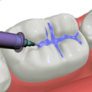 Selladores de fisuras